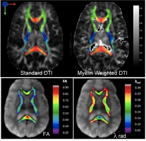 Myelin Water Weighted Diffusion Tensor Imaging