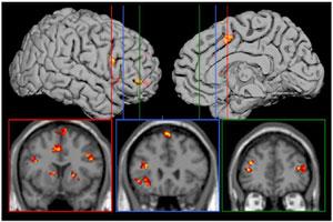 Pattern Recognition Brain Images