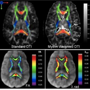 Myelin Water Weighted Diffusion Tensor Imaging