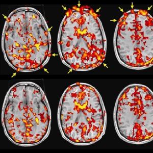 Uncorrected and corrected brain activation maps