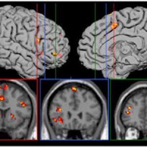 Pattern Recognition Brain Images